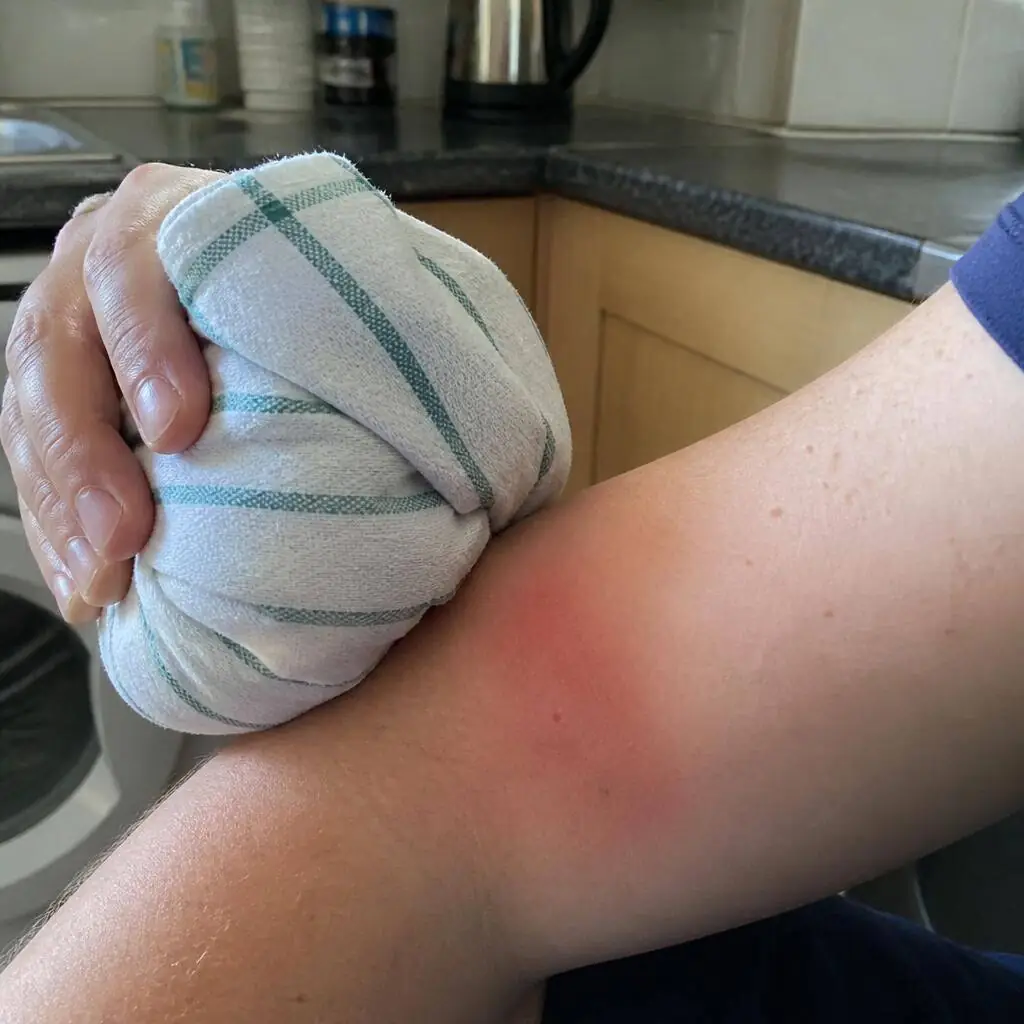 Applying a cold compress to a red wasp sting on a forearm